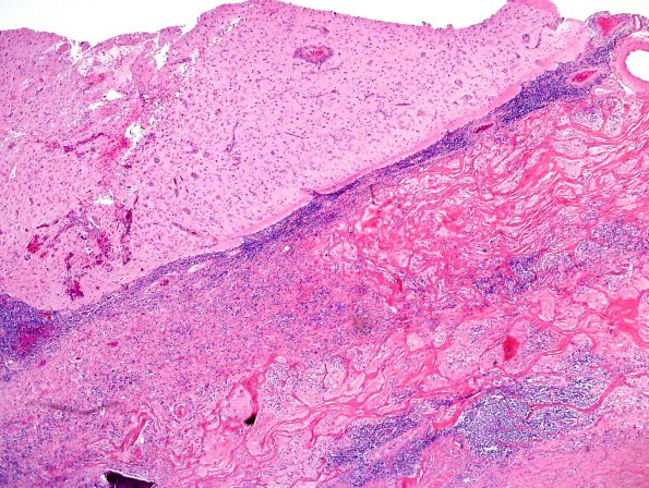 2A6 IgG4-Related Hypertrophic Pachymeningitis (Case 2) H&E 1