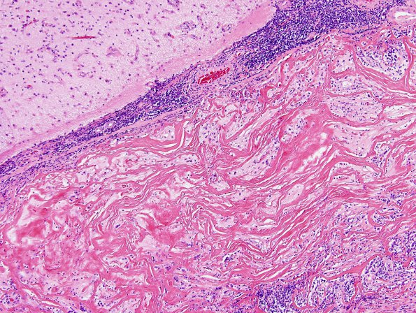 2A7 IgG4-Related Hypertrophic Pachymeningitis (Case 2) H&E 10X 6A