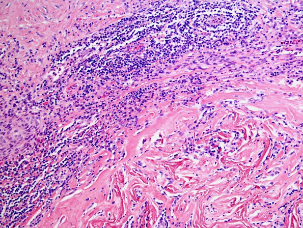 2A8 IgG4-Related Hypertrophic Pachymeningitis (Case 2) H&E 10