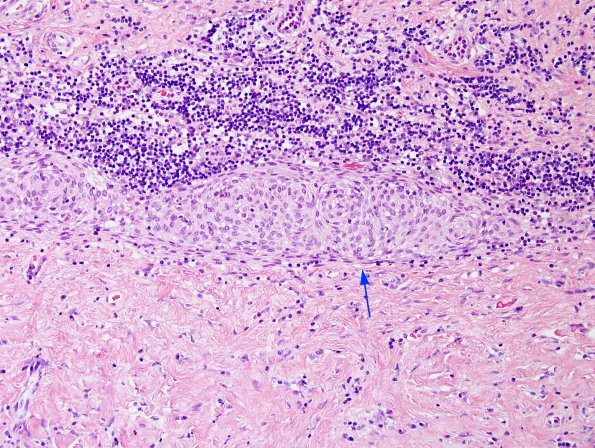 2A9 IgG4-Related Hypertrophic Pachymeningitis (Case 2) H&E 17 copy