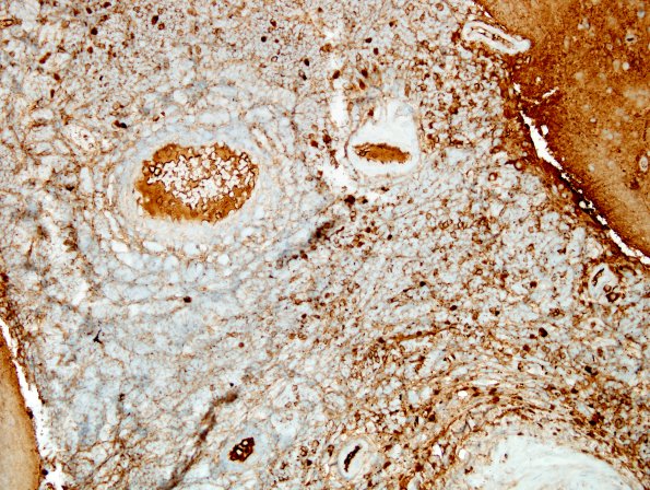 2B1 IgG4-Related Hypertrophic Pachymeningitis (Case 2) A1 IgG 3