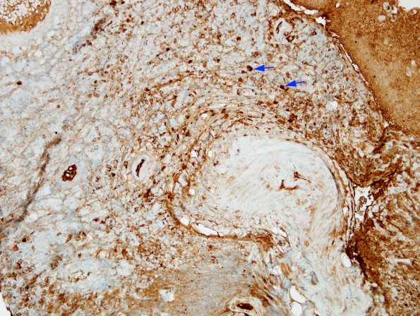 2B2 IgG4-Related Hypertrophic Pachymeningitis (Case 2) A1 IgG 1 copy