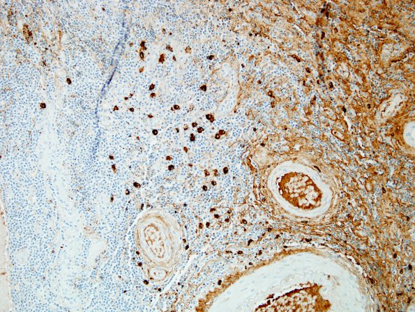 2C1 IgG4-Related Hypertrophic Pachymeningitis (Case 2) A1 IgG4 2