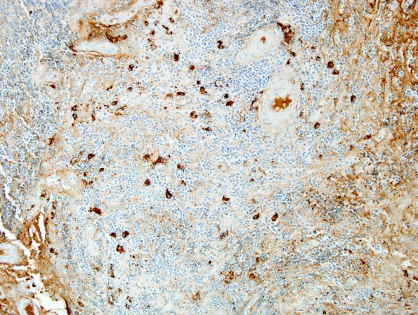 2C3 IgG4-Related Hypertrophic Pachymeningitis (Case 2) A1 IgG4 4.