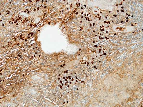 2C4 IgG4-Related Hypertrophic Pachymeningitis (Case 2) A2 IgG4 8