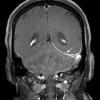 3A1 IgG4-related pachymeningitis (Case 3) T1 with contrast 1 copy