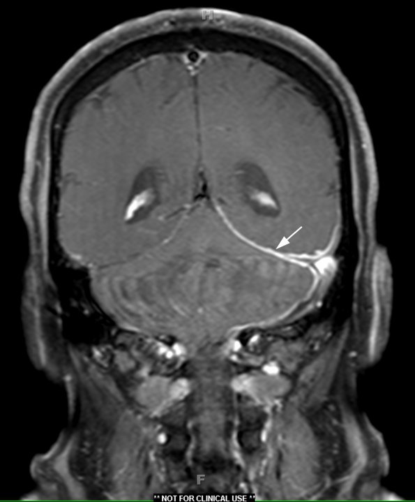 3A1 IgG4-related pachymeningitis (Case 3) T1 with contrast 1 copy