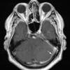 3A2 IgG4-related pachymeningitis (Case 3) T1 with contrast 2 copy