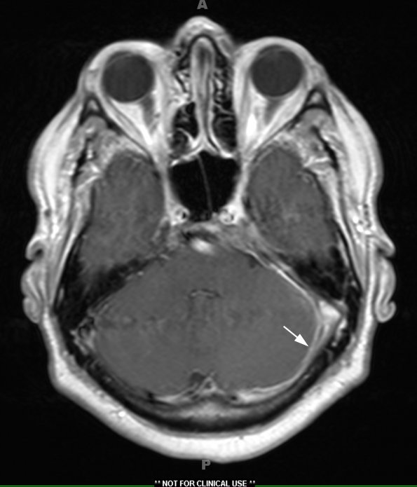 3A2 IgG4-related pachymeningitis (Case 3) T1 with contrast 2 copy