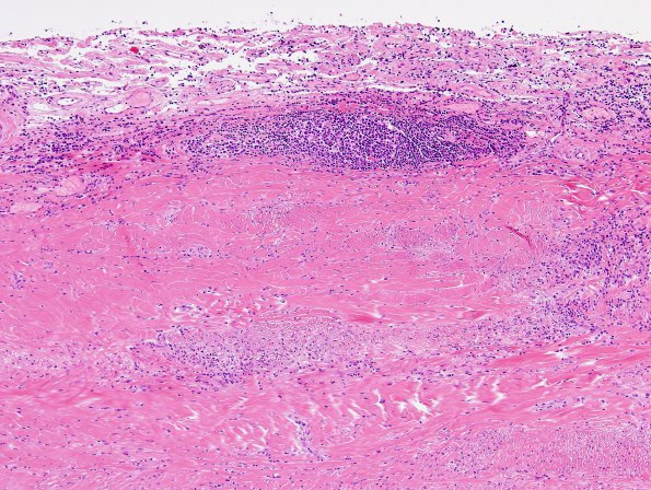 3B2 IgG4-related pachymeningitis (Case 3) H&E 2