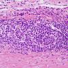 3B3 IgG4-related pachymeningitis (Case 3) H&E 5