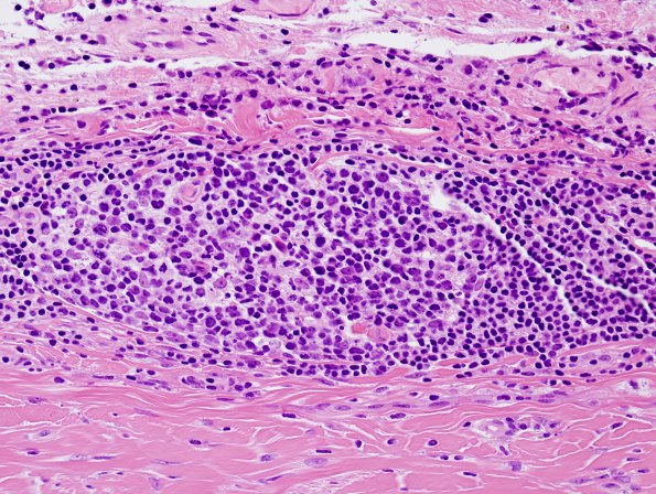 3B3 IgG4-related pachymeningitis (Case 3) H&E 5