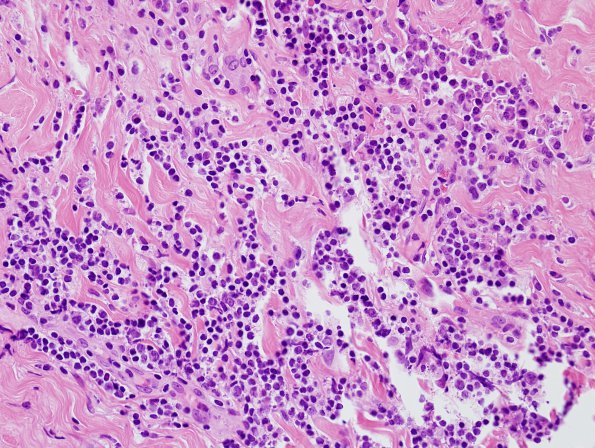 3B4 IgG4-related pachymeningitis (Case 3) H&E 6