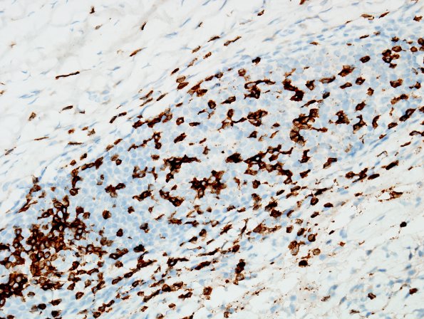 3C1 IgG4-related pachymeningitis (Case 3) CD3 1