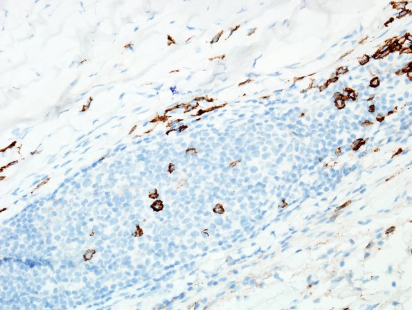 3D2 IgG4-related pachymeningitis (Case 3) CD138 2