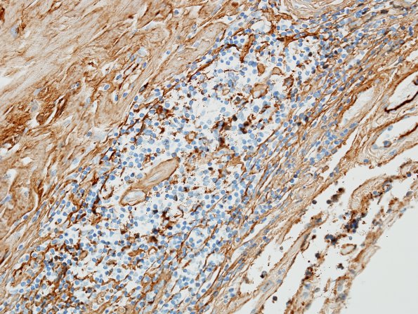 3E2 IgG4-related pachymeningitis (Case 3) IgG 2