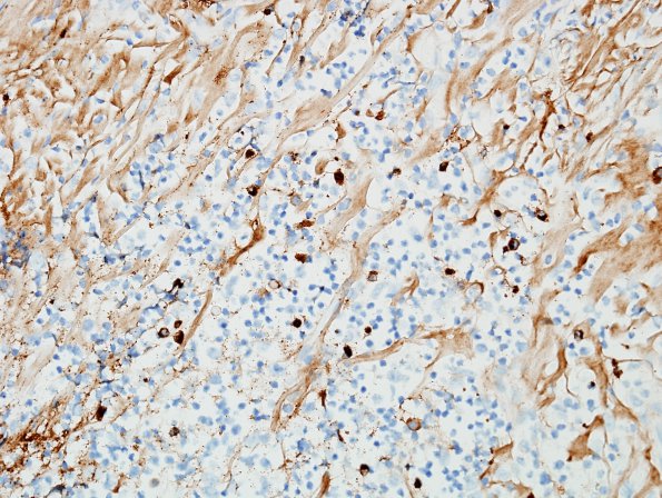 3F1 IgG4-related pachymeningitis (Case 3) IgG4 1