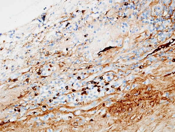 3F2 IgG4-related pachymeningitis (Case 3) IgG4 2