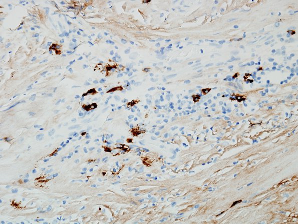 3F3 IgG4-related pachymeningitis (Case 3) IgG4 5