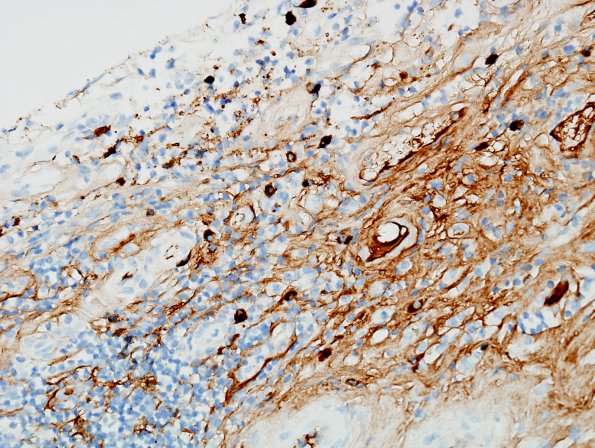 3F4 IgG4-related pachymeningitis (Case 3) IgG4 3