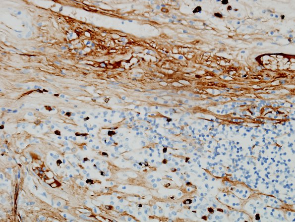 3F5 IgG4-related pachymeningitis (Case 3) IgG4 6