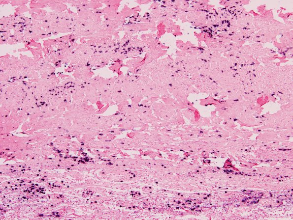 3G1 IgG4-related pachymeningitis (Case 3) ISH Lambda