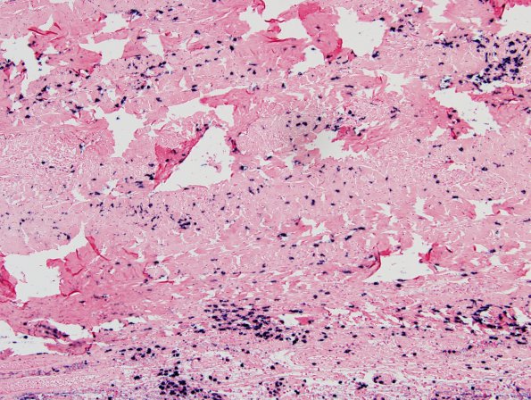 3G2 IgG4-related pachymeningitis (Case 3) ISH Kappa