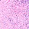 4A10 IgG4-Related Hypertrophic Pachymeningitis (AANP 2012 Case 8) H&E 10