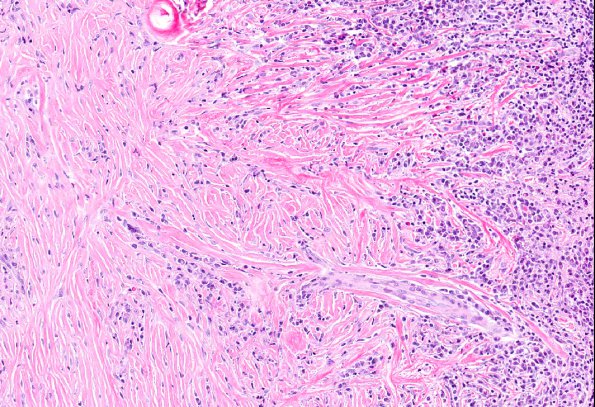 4A10 IgG4-Related Hypertrophic Pachymeningitis (AANP 2012 Case 8) H&E 10