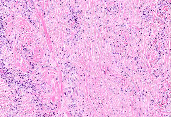 4A11 IgG4-Related Hypertrophic Pachymeningitis (AANP 2012 Case 8) H&E 11