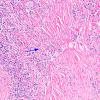 4A12 IgG4-Related Hypertrophic Pachymeningitis (AANP 2012 Case 8) H&E 14