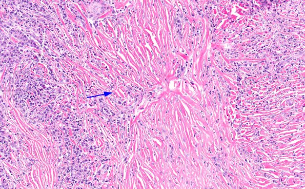 4A12 IgG4-Related Hypertrophic Pachymeningitis (AANP 2012 Case 8) H&E 14