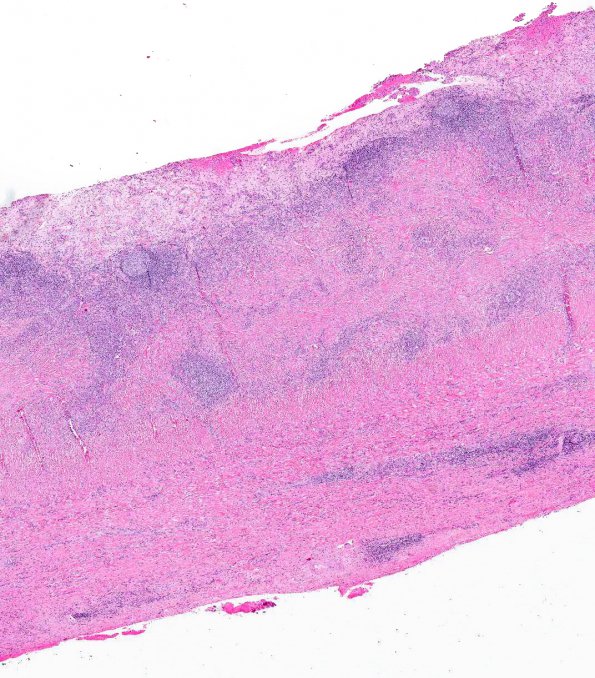 4A2 IgG4-Related Hypertrophic Pachymeningitis (AANP 2012 Case 8) H&E 2X