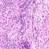 4A4 IgG4-Related Hypertrophic Pachymeningitis (AANP 2012 Case 8) H&E 20X 1