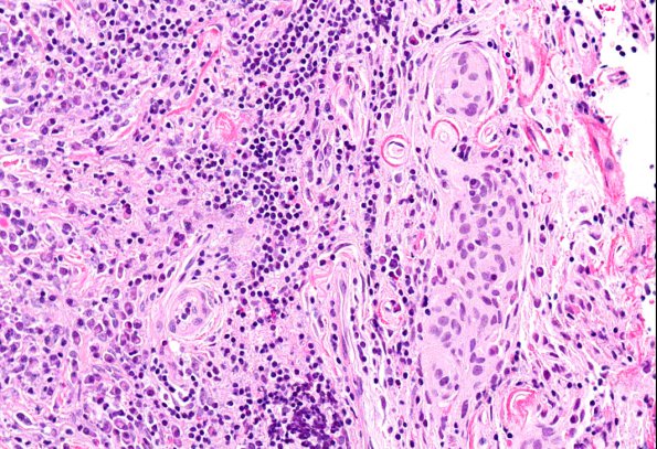 4A4 IgG4-Related Hypertrophic Pachymeningitis (AANP 2012 Case 8) H&E 20X 1