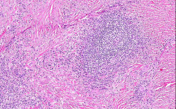 4A5 IgG4-Related Hypertrophic Pachymeningitis (AANP 2012 Case 8) H&E 11