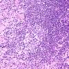 4A6 IgG4-Related Hypertrophic Pachymeningitis (AANP 2012 Case 8) H&E 18
