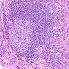 4A7 IgG4-Related Hypertrophic Pachymeningitis (AANP 2012 Case 8) H&E 20X 2