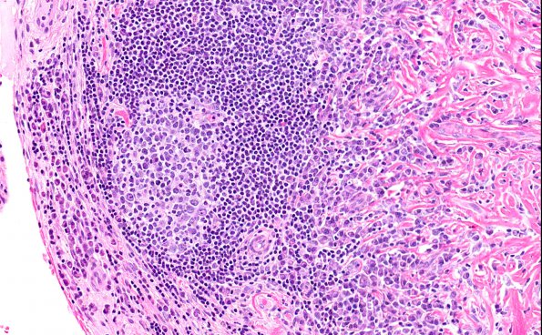 4A7 IgG4-Related Hypertrophic Pachymeningitis (AANP 2012 Case 8) H&E 20X 2