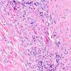 4A8 IgG4-Related Hypertrophic Pachymeningitis (AANP 2012 Case 8) H&E 20X 3 eosinophils copy copy