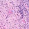4A9 IgG4-Related Hypertrophic Pachymeningitis (AANP 2012 Case 8) H&E 20X 3 copy