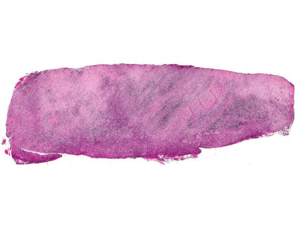 5A1 IIdiopathic Hypertrophic Pachymeningitis (AANP 1991, Case 8) H&E X1