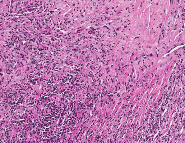 5A3 IIdiopathic Hypertrophic Pachymeningitis (AANP 1991, Case 8) H&E X20 3