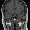 6A1 IgG4 Disease Adenohypophysis (Case 6) T1noC Pit