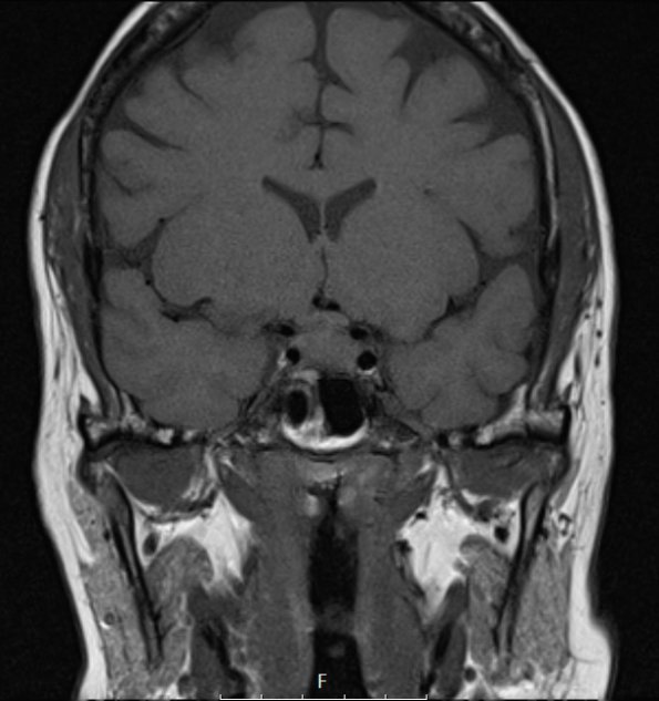 6A1 IgG4 Disease Adenohypophysis (Case 6) T1noC Pit