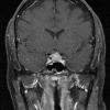 6A2 IgG4 Disease Adenohypophysis (Case 6) T1W Pit