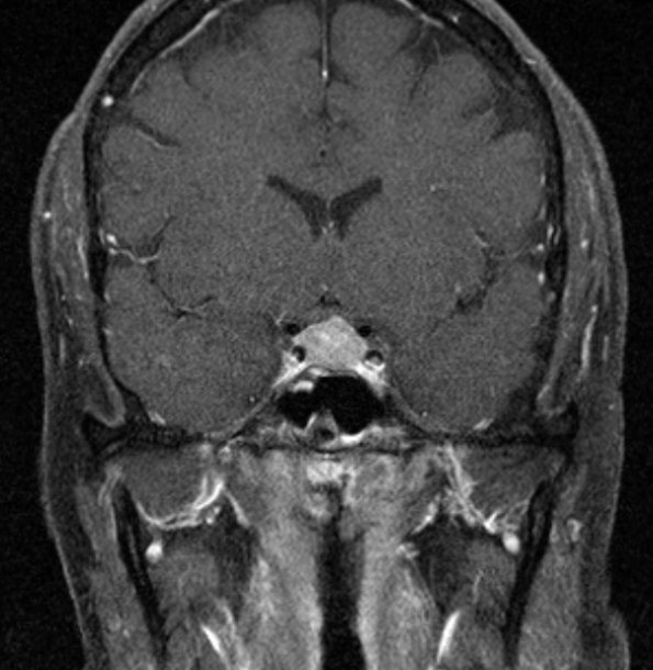 6A2 IgG4 Disease Adenohypophysis (Case 6) T1W Pit