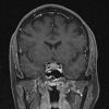 6A3 IgG4 Disease Adenohypophysis (Case 6) T1W Pit