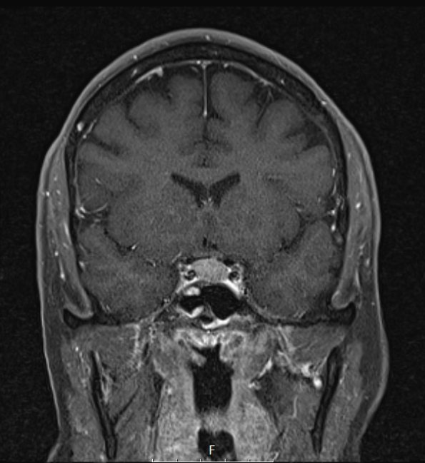 6A3 IgG4 Disease Adenohypophysis (Case 6) T1W Pit