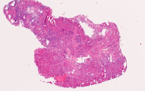 6B1 IgG4 Disease Adenohypophysis (Case 6) A2 H&E 4X